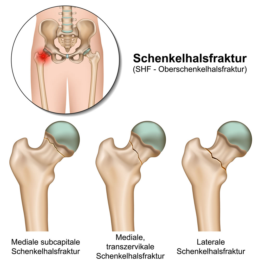 Oberschenkelhalsbruch