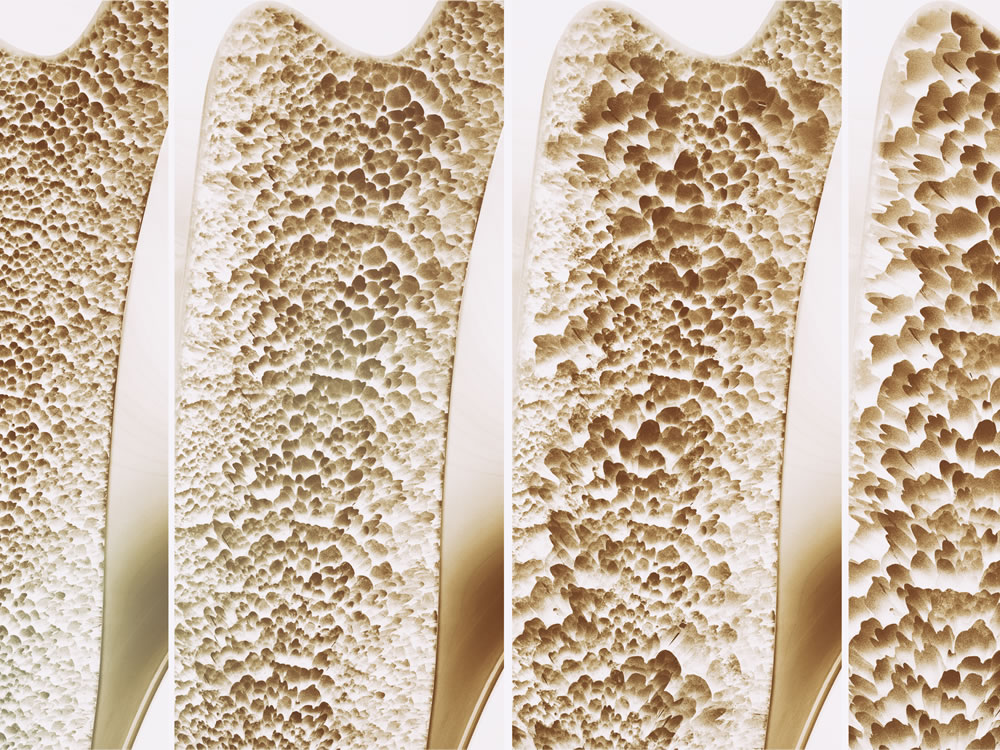 Osteoporose und Knochendichte